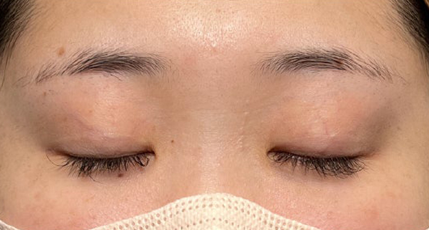 症例写真,埋没法で取れてしまった二重を、全切開法で希望の幅に整えた20代女性の症例写真,施術前,目を閉じた状態,mainpic_sekkai113b.jpg