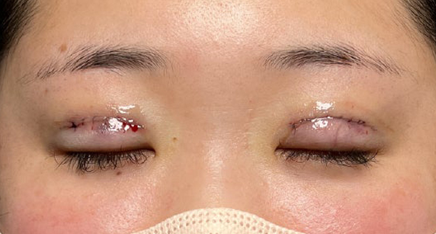 症例写真,埋没法で取れてしまった二重を、全切開法で希望の幅に整えた20代女性の症例写真,施術直後,目を閉じた状態,mainpic_sekkai113d.jpg