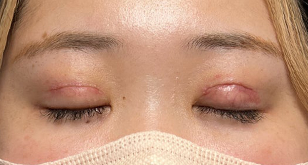 症例写真,埋没法で取れてしまった二重を、全切開法で希望の幅に整えた20代女性の症例写真,抜糸後（施術1週間後）,目を閉じた状態,mainpic_sekkai113f.jpg