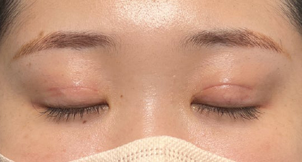 症例写真,埋没法で取れてしまった二重を、全切開法で希望の幅に整えた20代女性の症例写真,1ヶ月後,目を閉じた状態,mainpic_sekkai113h.jpg
