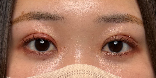 症例写真,埋没法で取れてしまった二重を、全切開法で希望の幅に整えた20代女性の症例写真,3ヶ月後,メイクあり,mainpic_sekkai113k.jpg