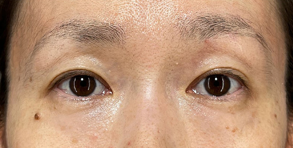 厚みと重たさのある瞼に二重まぶた・埋没法（二針固定）を行った症例写真,After（1ヶ月後）,ba_maibotsu091_a01.jpg