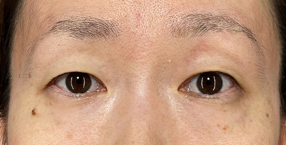 厚みと重たさのある瞼に二重まぶた・埋没法（二針固定）を行った症例写真,Before,ba_maibotsu091_b01.jpg