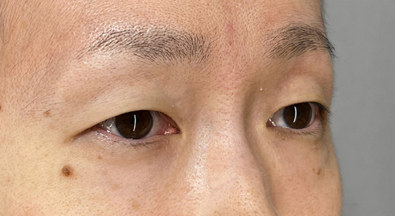 症例写真,厚みと重たさのある瞼に二重まぶた・埋没法（二針固定）を行った症例写真,Before,ba_maibotsu091_b02.jpg