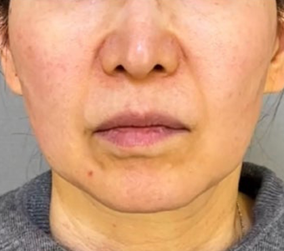 脂肪吸引（頬、あご下）,ミニフェイスリフト（頬のたるみ取り）,脂肪吸引,ミニフェイスリフトとあご下の脂肪吸引を行った症例写真,Before,ba_minilift028_b01.jpg