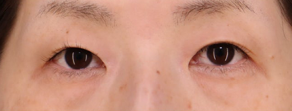 目の下の脂肪取り,目の下の切らない脂肪取りを行った40代女性の症例写真,Before,ba_shibo_under018_b01.jpg