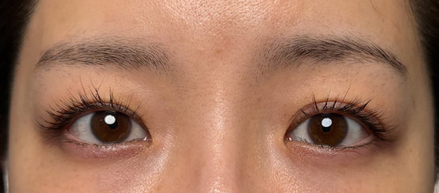 二重まぶた・連続埋没法,連続埋没法で二重の左右差を整え幅を広げた症例写真,施術前,mainpic_maibotsu3005a.jpg
