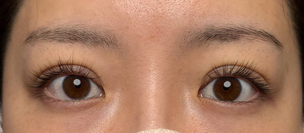 二重まぶた・連続埋没法,連続埋没法で二重の左右差を整え幅を広げた症例写真,施術直後,mainpic_maibotsu3005b.jpg