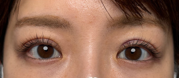 二重まぶた・連続埋没法,連続埋没法で二重の左右差を整え幅を広げた症例写真,翌日,mainpic_maibotsu3005c.jpg