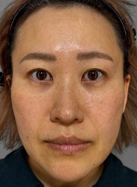 あご注射（ヒアルロン酸）,注射式シワ取り 長期持続型ヒアルロン酸注入,イタリアンリフト,イタリアンリフト、あご注射（ヒアルロン酸）、シワ取りヒアルロン酸注射を行った症例写真,After（3ヶ月後）,ba_italian040_a01.jpg