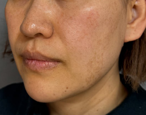 イタリアンリフト,イタリアンリフト、あご注射（ヒアルロン酸）、シワ取りヒアルロン酸注射を行った症例写真,After（3ヶ月後）,ba_italian040_b02.jpg