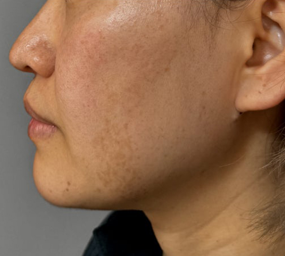 イタリアンリフト,イタリアンリフト、あご注射（ヒアルロン酸）、シワ取りヒアルロン酸注射を行った症例写真,After（3ヶ月後）,ba_italian040_b03.jpg