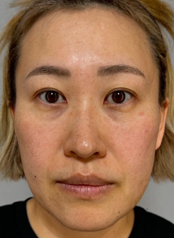 あご注射（ヒアルロン酸）,注射式シワ取り 長期持続型ヒアルロン酸注入,イタリアンリフト,イタリアンリフト、あご注射（ヒアルロン酸）、シワ取りヒアルロン酸注射を行った症例写真,Before,ba_italian040_b01.jpg