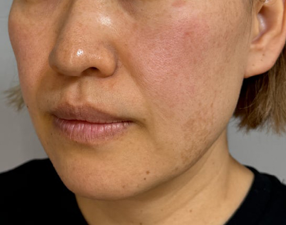 イタリアンリフト,イタリアンリフト、あご注射（ヒアルロン酸）、シワ取りヒアルロン酸注射を行った症例写真,Before,ba_italian040_b02.jpg