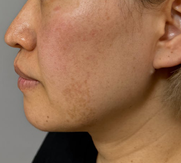 イタリアンリフト,イタリアンリフト、あご注射（ヒアルロン酸）、シワ取りヒアルロン酸注射を行った症例写真,Before,ba_italian040_b03.jpg