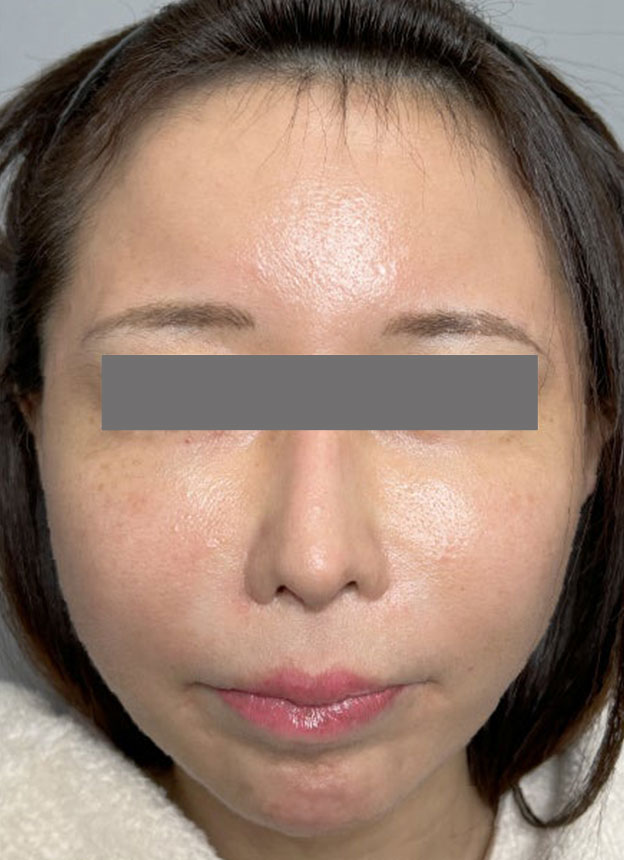 症例写真,頬に脂肪注入を行ってコケた印象を改善した症例写真,1週間後,mainpic_faceshibo006b.jpg