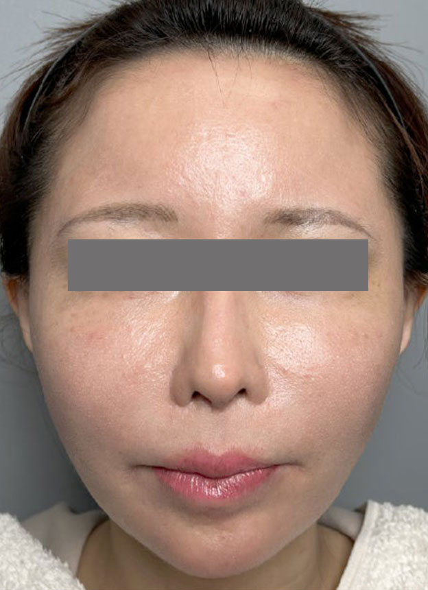 症例写真,頬に脂肪注入を行ってコケた印象を改善した症例写真,1ヶ月後,mainpic_faceshibo006c.jpg