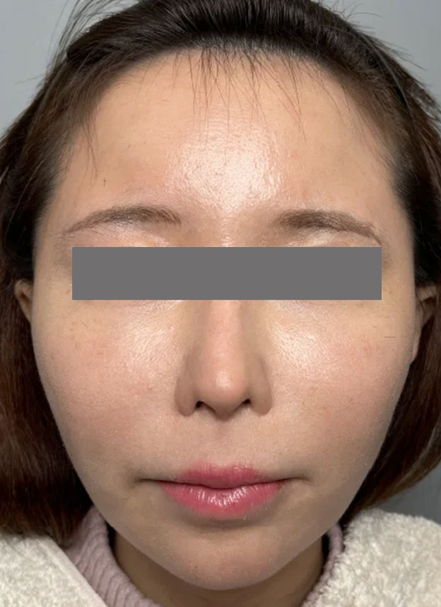 症例写真,頬に脂肪注入を行ってコケた印象を改善した症例写真,3ヶ月後,mainpic_faceshibo006d.jpg