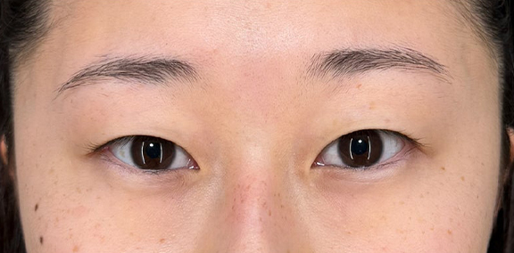 二重まぶた・埋没法（二針固定）を行い、より目力のある目元になった症例写真,Before,ba_maibotsu092_b01.jpg
