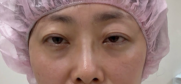 右眼瞼の眼瞼下垂に対して埋没法を行った40代女性の症例写真,After,ba_maibotsu093_a01.jpg