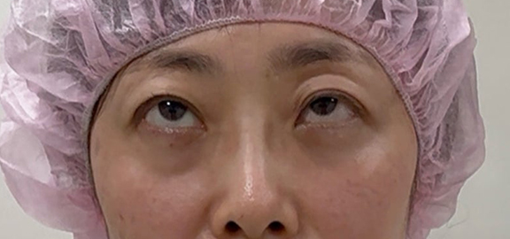症例写真,右眼瞼の眼瞼下垂に対して埋没法を行った40代女性の症例写真,After,ba_maibotsu093_b02.jpg