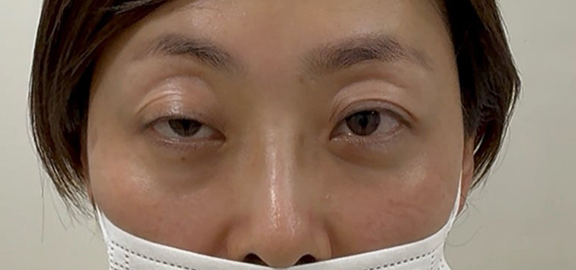 右眼瞼の眼瞼下垂に対して埋没法を行った40代女性の症例写真,Before,ba_maibotsu093_b01.jpg