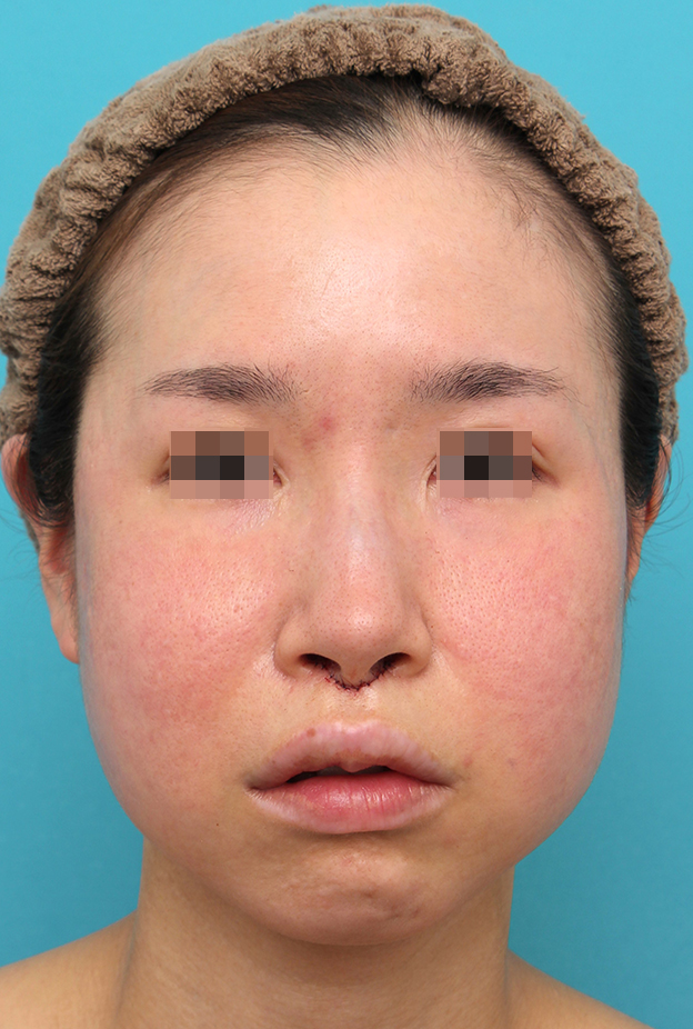 バッカルファット除去,人中短縮手術とバッカルファット除去を同時に行った30代女性の症例写真,手術直後,mainpic_hanashita014b.jpg