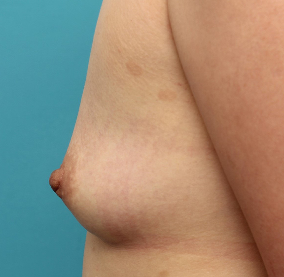 症例写真,30代女性の重度陥没乳頭を手術で改善させた症例写真,After（6ヶ月後）,ba_kanbotsu007_b03.jpg