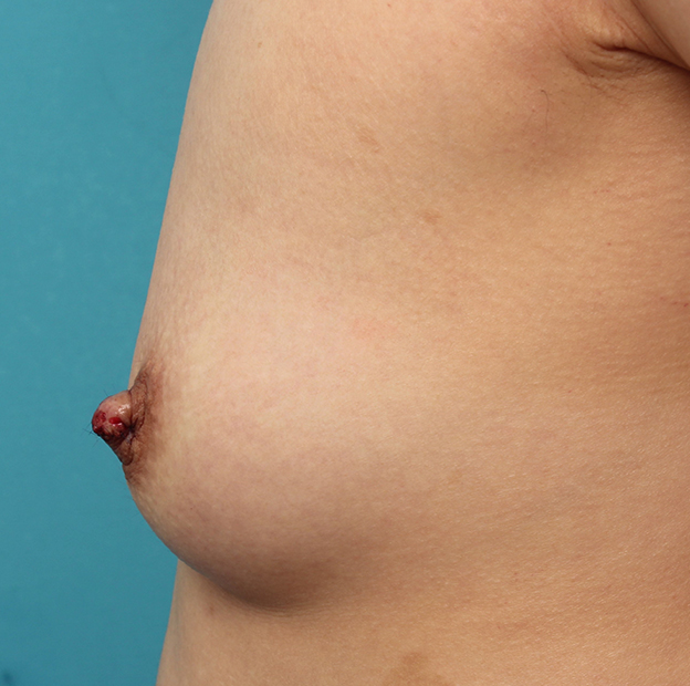 症例写真,30代女性の重度陥没乳頭を手術で改善させた症例写真,手術直後,mainpic_kanbotsu007j.jpg