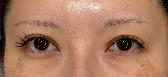 二重まぶた・全切開法でまつ毛のキワがしっかり見えるようにした症例写真,After（1ヶ月後）,ba_sekkai115_a01.jpg