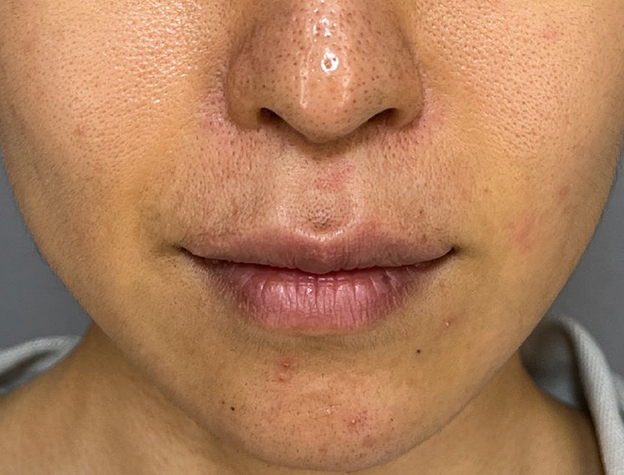 症例写真,上口唇リフト（人中短縮、リップリフト）の症例写真,施術前,mainpic_hanashita015a.jpg