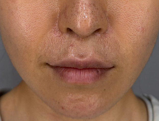 症例写真,上口唇リフト（人中短縮、リップリフト）の症例写真,1年後,mainpic_hanashita015c.jpg