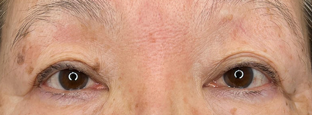 症例写真,眼瞼下垂手術で末広型の二重を作り目を開きやすくした症例写真,施術前,mainpic_ganken053a.jpg