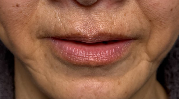唇を薄く（口唇縮小術）,下唇を薄くした60代女性の症例写真,After（口を開けた状態）<br/>
（3ヶ月後）,