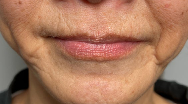 唇を薄く（口唇縮小術）,下唇を薄くした60代女性の症例写真,施術前,mainpic_usuku030a.jpg