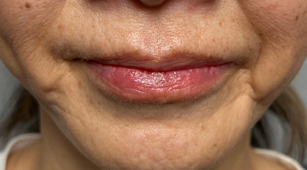 唇を薄く（口唇縮小術）,下唇を薄くした60代女性の症例写真,2週間後,mainpic_usuku030c.jpg