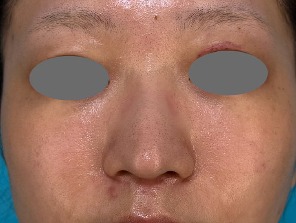 症例写真,鼻尖の高さを変えずに鼻柱を前方に出した耳介軟骨移植の症例写真,Before,ba_jikai059_b02.jpg