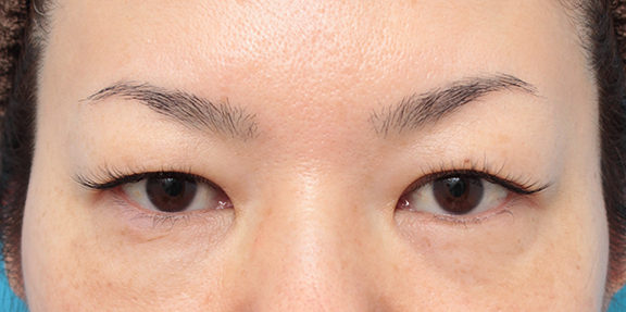 非常に分厚い上まぶたに対してたるみ取り手術を行った40代女性症例写真,Before,ba_tarumi016_b01.jpg