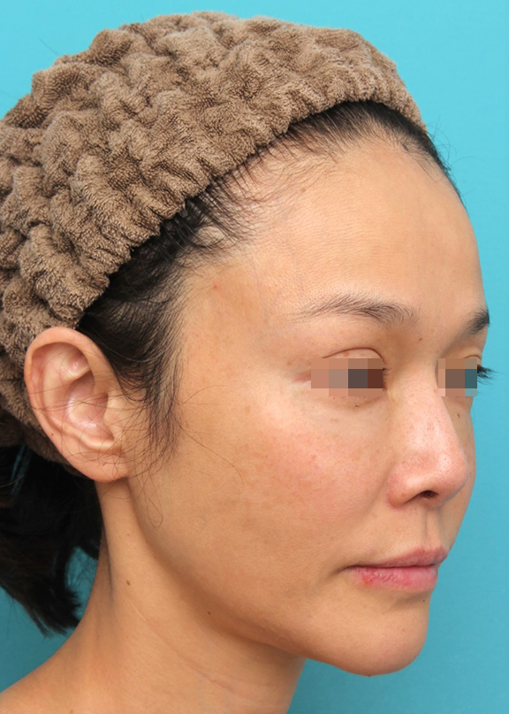 症例写真,鼻翼基部プロテーゼ（貴族手術）を行った40代女性の症例写真,After（6ヶ月後）,ba_biyokukibu002_b02.jpg