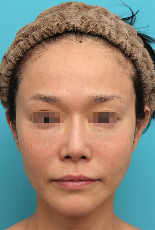症例写真,鼻翼基部プロテーゼ（貴族手術）を行った40代女性の症例写真,手術前,mainpic_biyokukibu002a.jpg