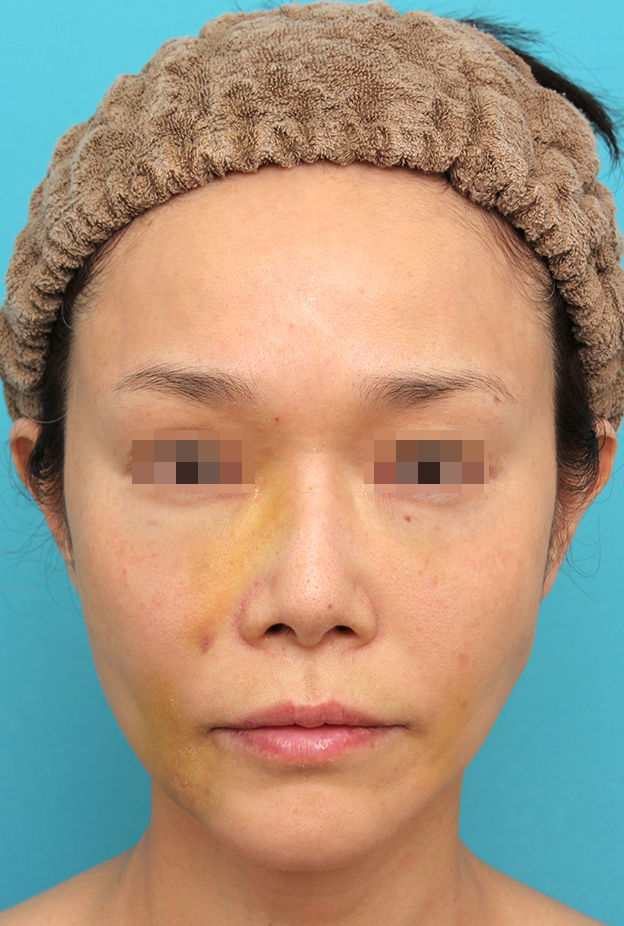 症例写真,鼻翼基部プロテーゼ（貴族手術）を行った40代女性の症例写真,1週間後,mainpic_biyokukibu002c.jpg