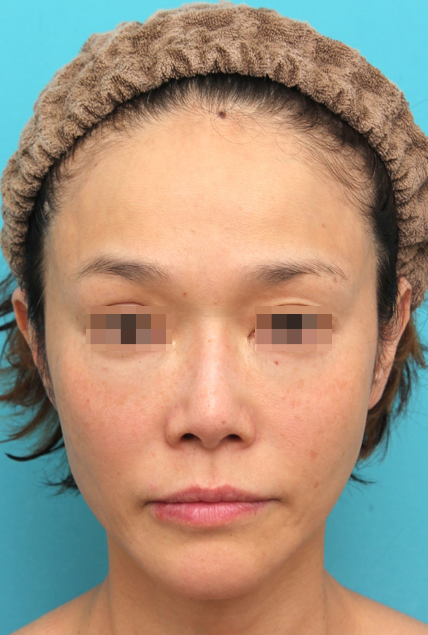 症例写真,鼻翼基部プロテーゼ（貴族手術）を行った40代女性の症例写真,6ヶ月後,mainpic_biyokukibu002d.jpg