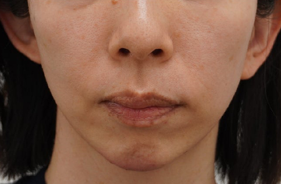 脂肪吸引を行わずにたるみを引き締めるミニフェイスリフトの症例写真,After（10ヶ月後）,ba_minilift030_a01.jpg