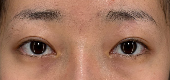 目を大きくしたい、まつ毛の生え際を見せたいというご希望の患者様に二重全切開・目頭切開を行った症例写真,Before,ba_sekkai117_b01.jpg