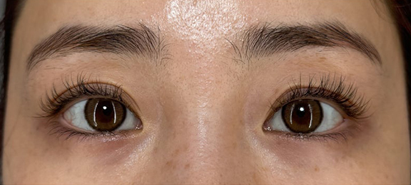 当日からメイクができる裏留め埋没法,当日からメイクができる裏留め埋没法で二重の幅を広げた症例写真,After（2週間後）,ba_maibotsu2014_a01.jpg