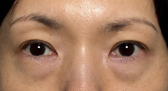 目の下の切らない脂肪取りで目の下の膨らみ・クマを改善した症例写真,Before,ba_shibo_under019_b01.jpg