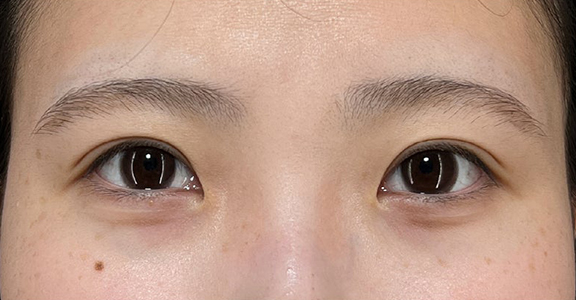 二重まぶた･埋没法（一針固定）で自然な二重を作った症例写真,After（1ヶ月後）,ba_maibotsu094_a01.jpg