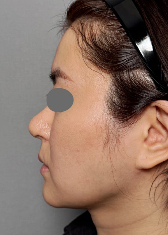 症例写真,耳介軟骨移植と鼻尖形成を同時に行った症例写真,After（1ヶ月後）,ba_jikai060_b03.jpg