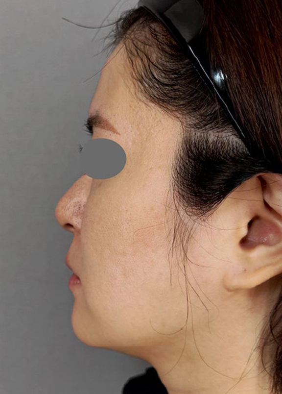 症例写真,耳介軟骨移植と鼻尖形成を同時に行った症例写真,Before,ba_jikai060_b03.jpg