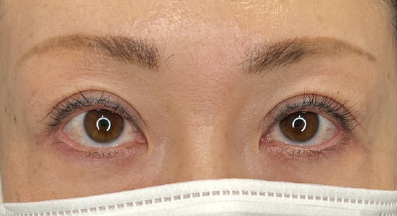 上まぶたたるみ取り,上まぶたのたるみ取りで二重のラインも整えた症例写真,After（メイクなし）
（3ヶ月後）,ba_tarumi020_a01.jpg